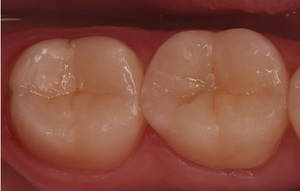 keramische Inlays