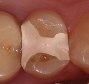 Füllung aus Dentalzement Füllung aus Dentalzement