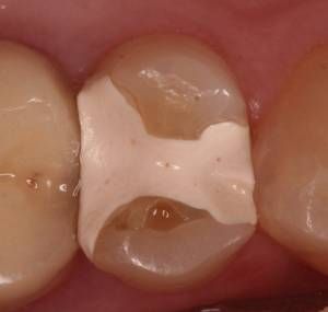  Füllung aus Dentalzement