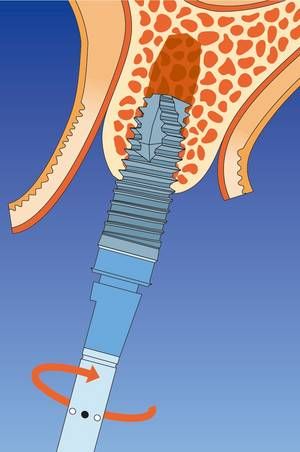 Einbringen des Implantates Einbringen des Implantates